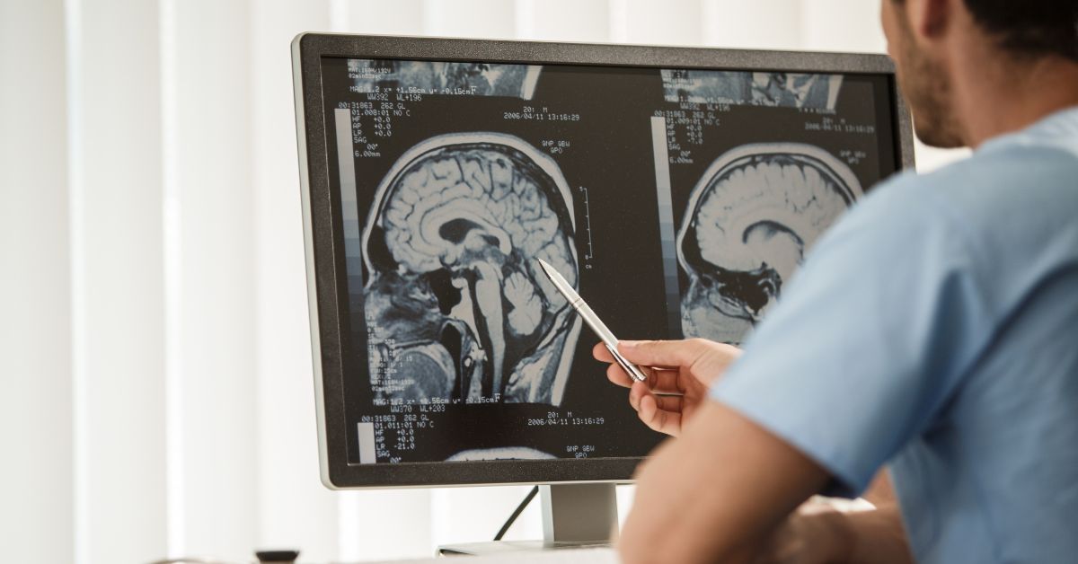 Tumor Otak:  Ini Penyebab, Cara Deteksi, dan Pengobatannya